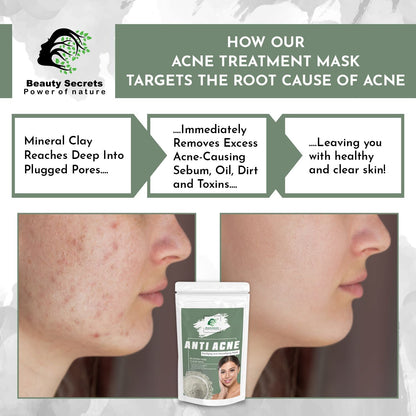 ANTI ACNE FACE MASK FOR PURIFYING AND DETOXIFYING